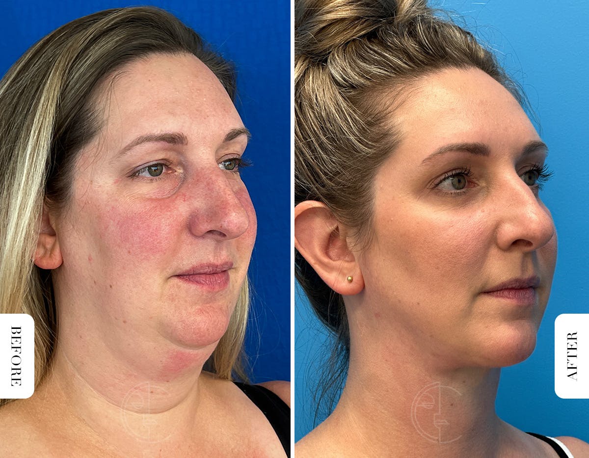 Miami Lower Eyelid Lift Before & After Gallery - Patient 804869 - Image 2 - The Chopra Plastic Surgery Center