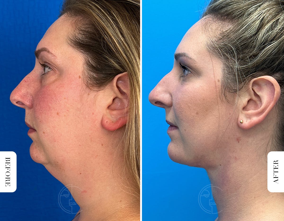 Miami Lower Eyelid Lift Before & After Gallery - Patient 804869 - Image 5 - The Chopra Plastic Surgery Center