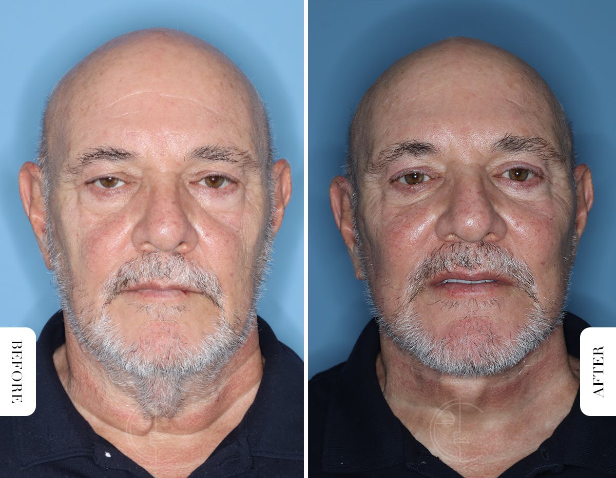 Miami Male Facelift & Neck Lift Before & After Gallery - Patient 331471 - Image 1 - The Chopra Plastic Surgery Center