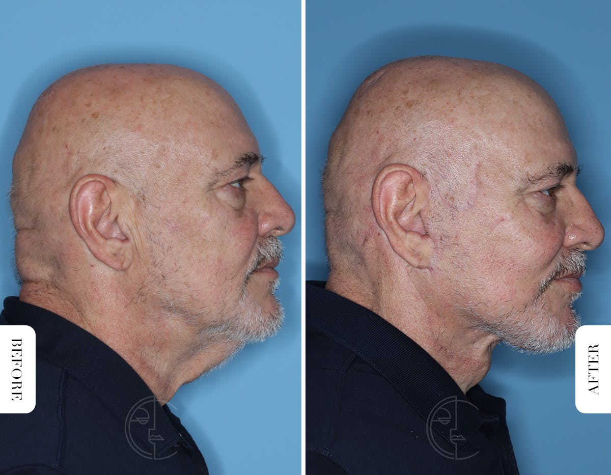 Miami Male Facelift & Neck Lift Before & After Gallery - Patient 331471 - Image 3 - The Chopra Plastic Surgery Center