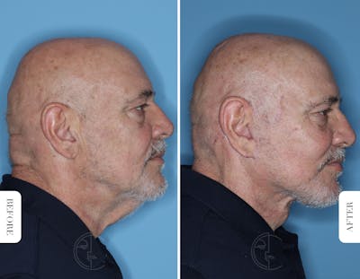 Miami Male Neck Lift Before & After Gallery - Patient 423270 - Image 1 - The Chopra Plastic Surgery Center
