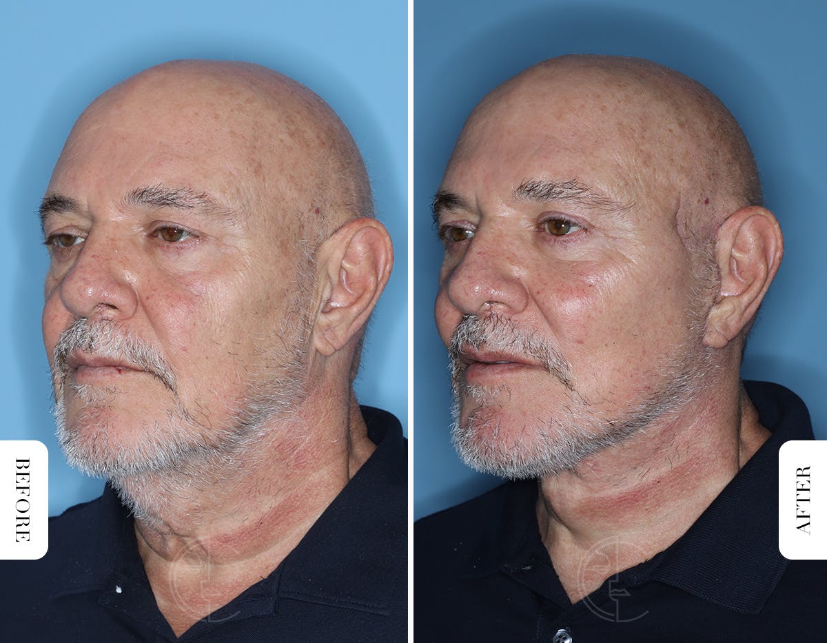 Miami Male Facelift & Neck Lift Before & After Gallery - Patient 331471 - Image 4 - The Chopra Plastic Surgery Center