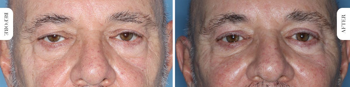 Miami Upper Eyelid Lift Before & After Gallery - Patient 421485 - Image 1 - The Chopra Plastic Surgery Center