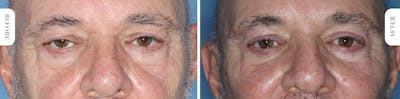 Miami Upper Eyelid Lift Before & After Gallery - Patient 421485 - Image 1 - The Chopra Plastic Surgery Center
