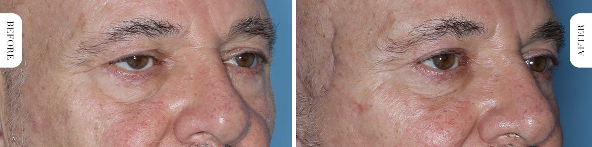 Miami Upper Eyelid Lift Before & After Gallery - Patient 421485 - Image 2 - The Chopra Plastic Surgery Center