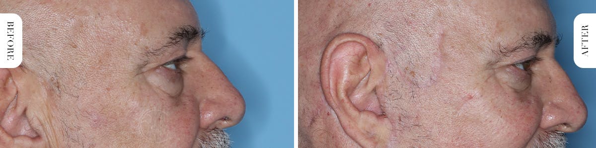 Miami Upper Eyelid Lift Before & After Gallery - Patient 421485 - Image 3 - The Chopra Plastic Surgery Center