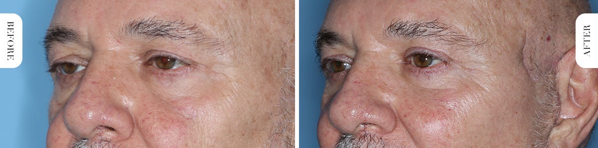Miami Upper Eyelid Lift Before & After Gallery - Patient 421485 - Image 4 - The Chopra Plastic Surgery Center