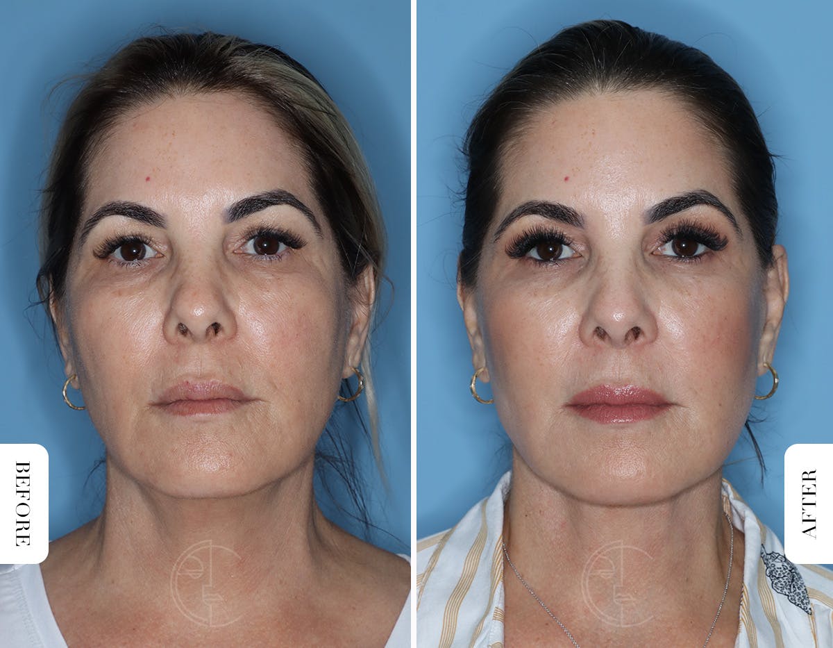 Miami Facelift/Neck Lift Before & After Gallery - Patient 329163 - Image 1 - The Chopra Plastic Surgery Center