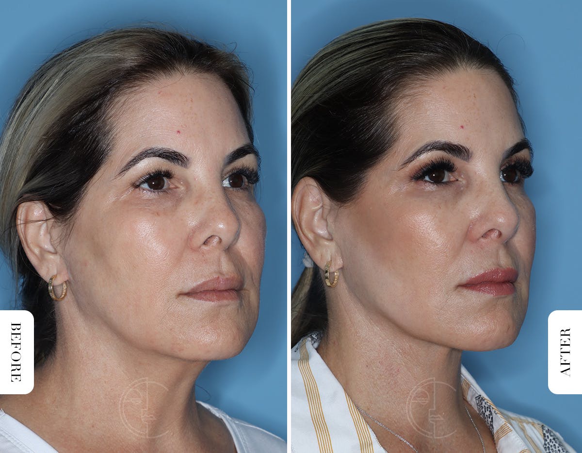 Miami Facelift/Neck Lift Before & After Gallery - Patient 329163 - Image 2 - The Chopra Plastic Surgery Center