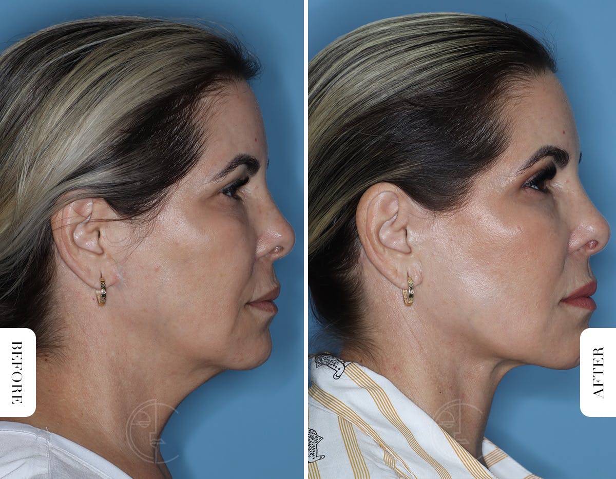Miami Facelift/Neck Lift Before & After Gallery - Patient 329163 - Image 3 - The Chopra Plastic Surgery Center