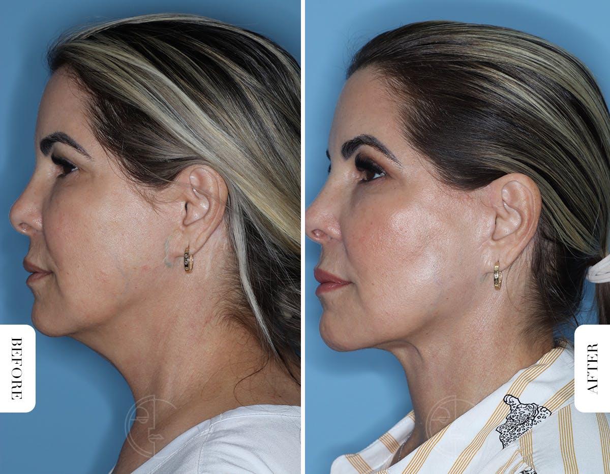 Miami Facelift/Neck Lift Before & After Gallery - Patient 329163 - Image 5 - The Chopra Plastic Surgery Center