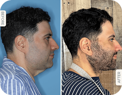 Miami Male Facelift & Neck Lift Before & After Gallery - Patient 235667 - Image 1 - The Chopra Plastic Surgery Center