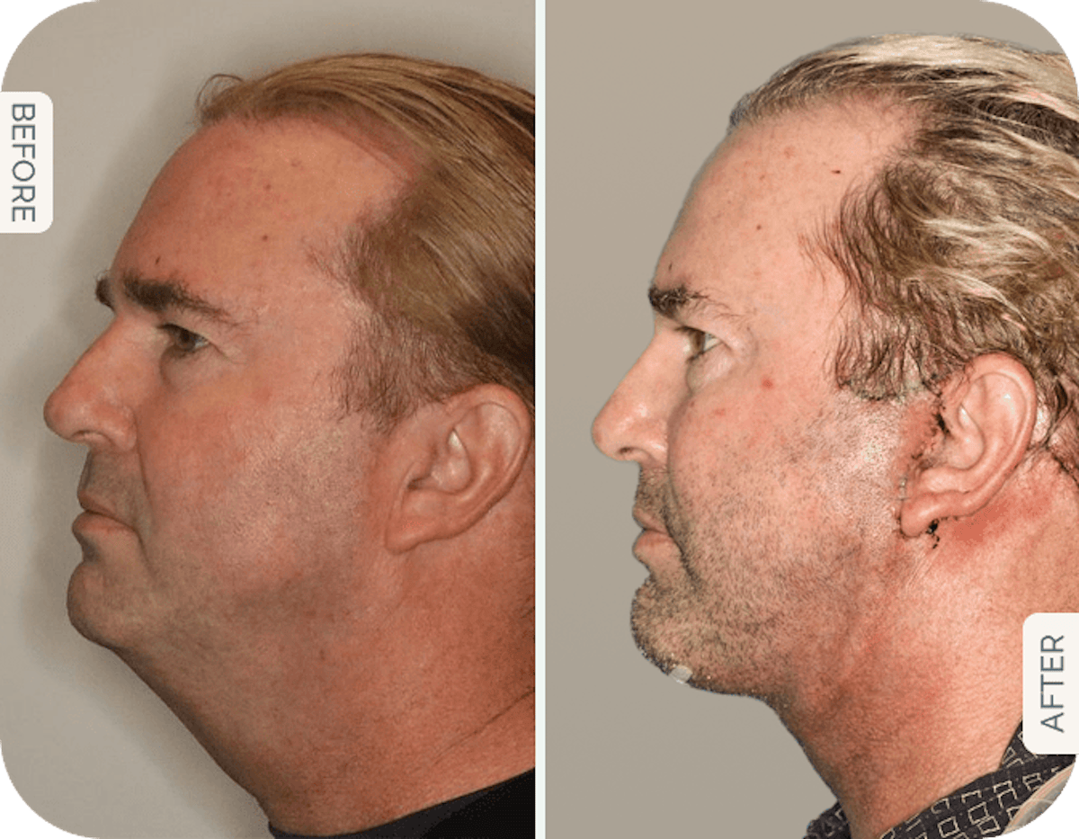 Miami Male Facelift & Neck Lift Before & After Gallery - Patient 157269 - Image 1 - The Chopra Plastic Surgery Center