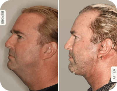 Miami Male Facelift & Neck Lift Before & After Gallery - Patient 157269 - Image 1 - The Chopra Plastic Surgery Center