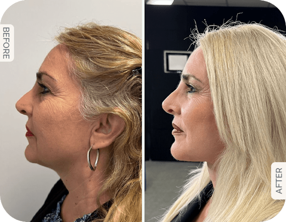 Miami Facelift/Neck Lift Before & After Gallery - Patient 339990 - Image 1 - The Chopra Plastic Surgery Center