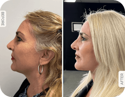 Miami Facelift/Neck Lift Before & After Gallery - Patient 339990 - Image 1 - The Chopra Plastic Surgery Center