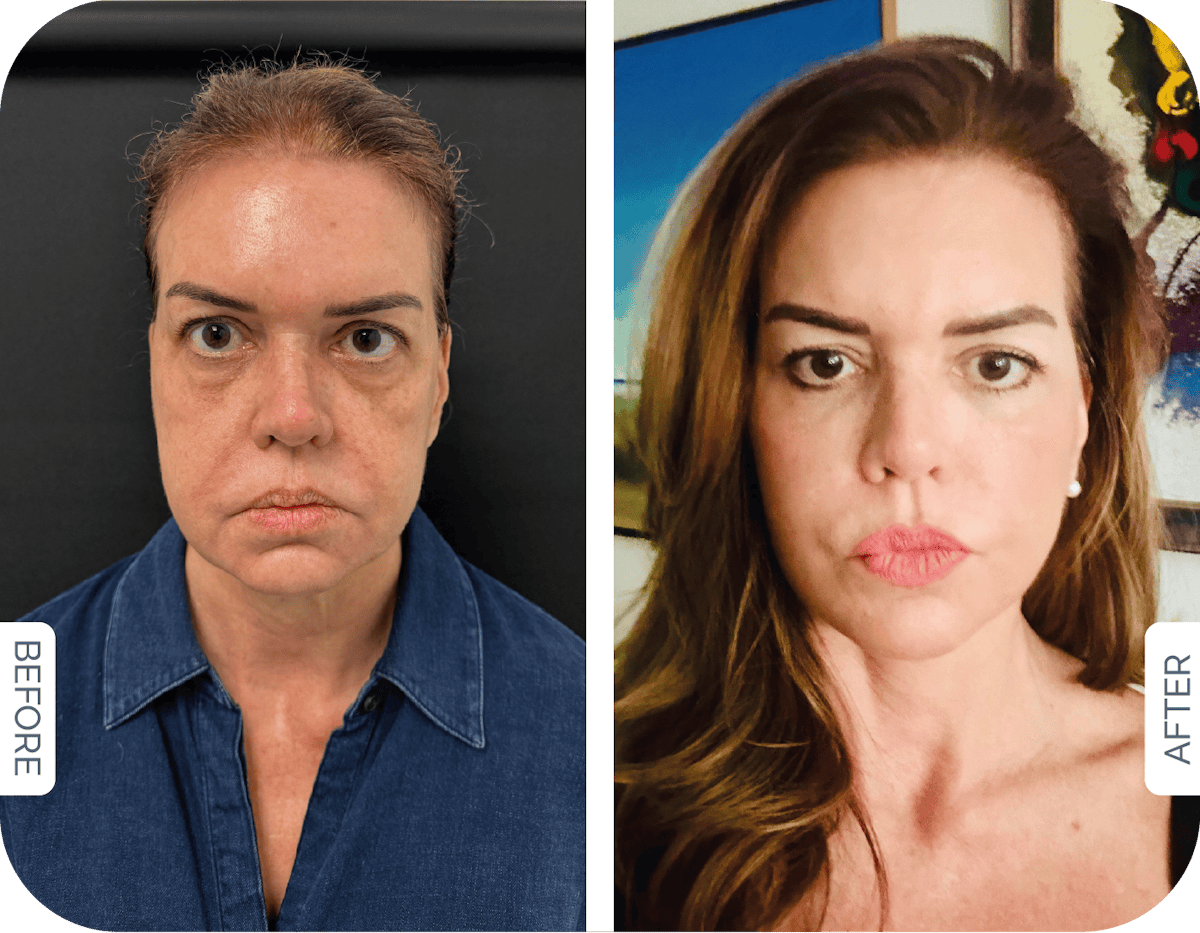 Miami Buccal Fat Pad Removal Before & After Gallery - Patient 859156 - Image 1 - The Chopra Plastic Surgery Center