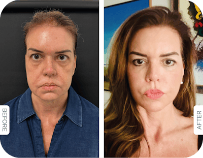 Miami Buccal Fat Pad Removal Before & After Gallery - Patient 859156 - Image 1 - The Chopra Plastic Surgery Center