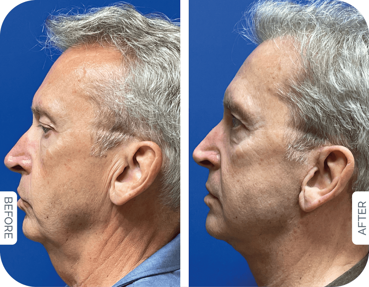 Miami Facelift/Neck Lift Before & After Gallery - Patient 325531 - Image 1 - The Chopra Plastic Surgery Center