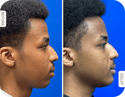 Miami Chin Augmentation Before & After Gallery - Patient 335822 - Image 1 - The Chopra Plastic Surgery Center