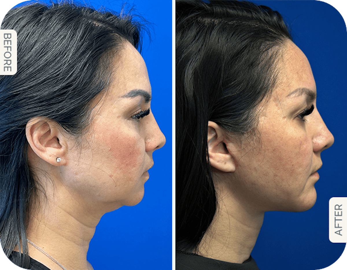 Miami Chin Augmentation Before & After Gallery - Patient 426030 - Image 1 - The Chopra Plastic Surgery Center