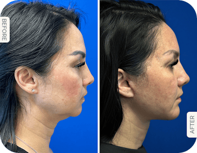 Miami Chin Augmentation Before & After Gallery - Patient 426030 - Image 1 - The Chopra Plastic Surgery Center