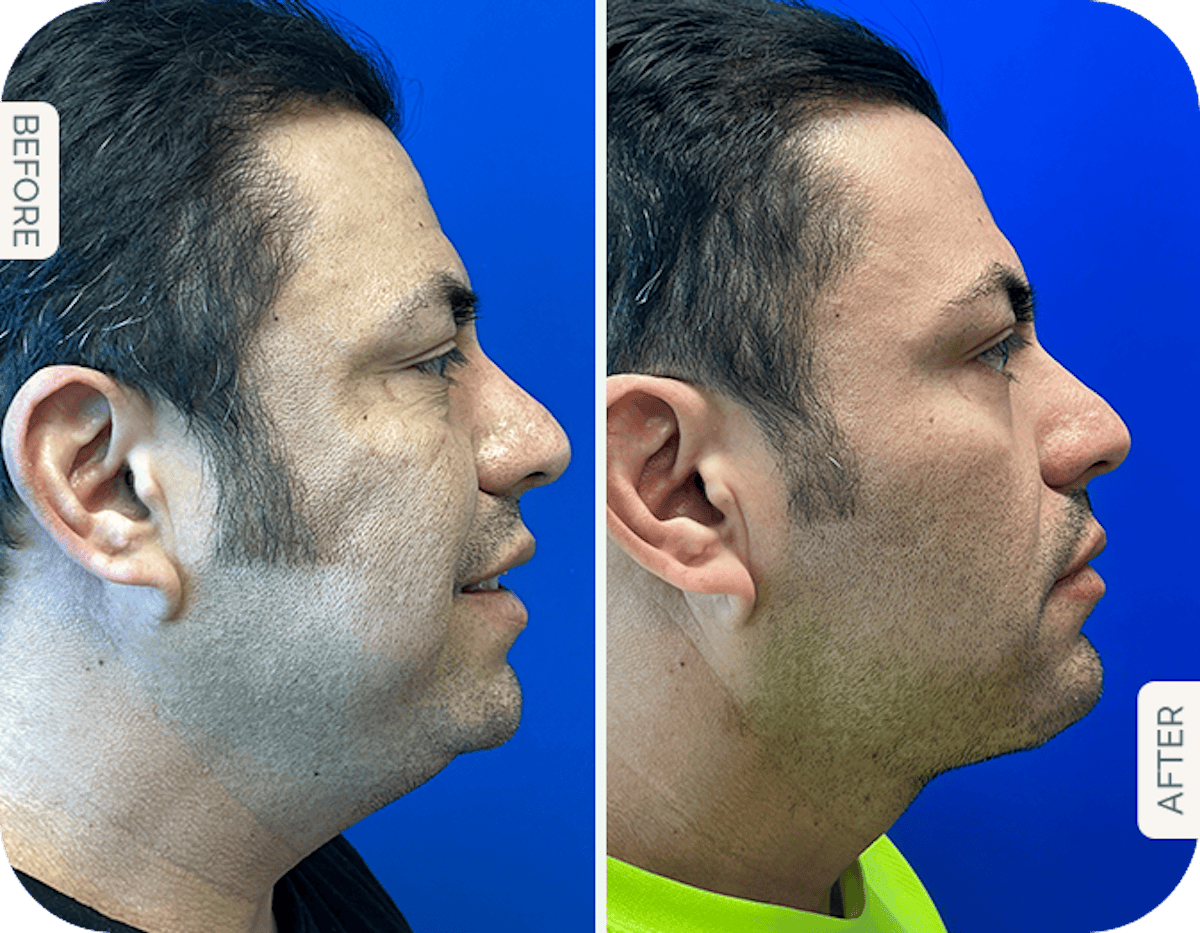 Miami Chin Augmentation Before & After Gallery - Patient 715350 - Image 1 - The Chopra Plastic Surgery Center