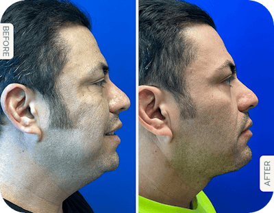 Miami Chin Augmentation Before & After Gallery - Patient 715350 - Image 1 - The Chopra Plastic Surgery Center