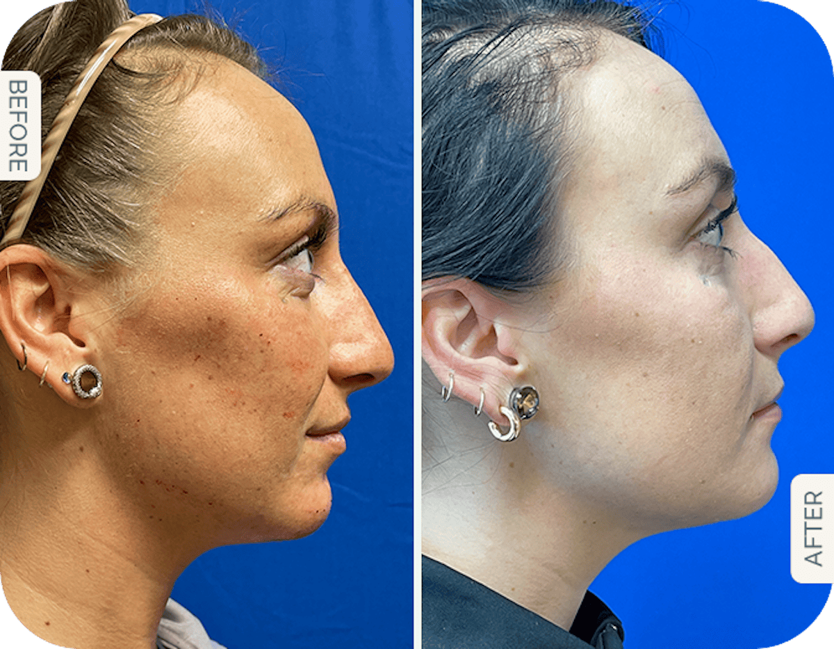 Miami Chin Augmentation Before & After Gallery - Patient 252762 - Image 1 - The Chopra Plastic Surgery Center