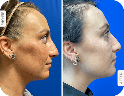 Miami Chin Augmentation Before & After Gallery - Patient 252762 - Image 1 - The Chopra Plastic Surgery Center