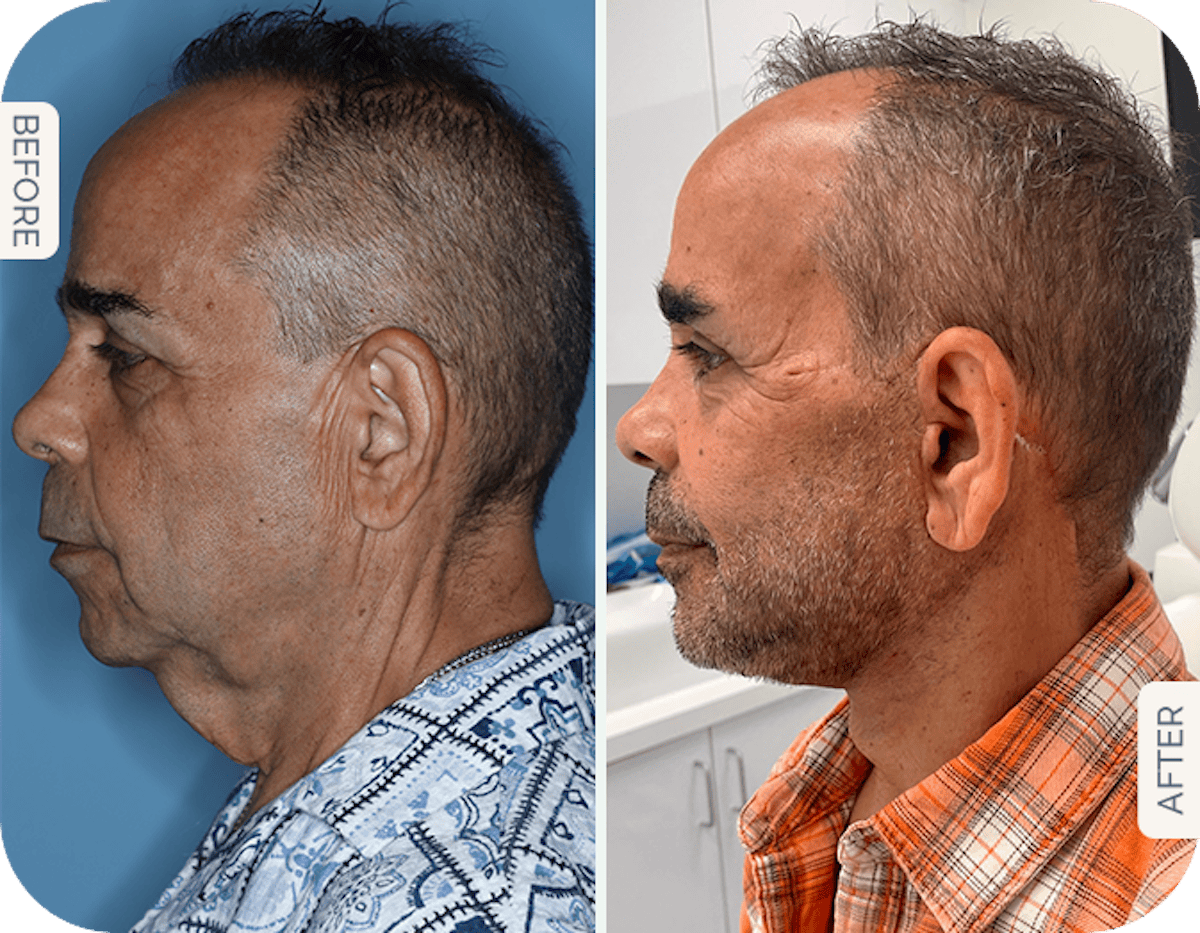 Miami Facelift/Neck Lift Before & After Gallery - Patient 189945 - Image 1 - The Chopra Plastic Surgery Center
