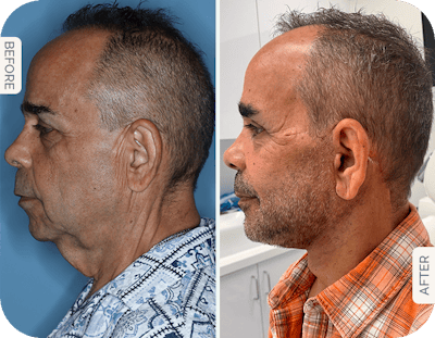 Miami Male Facelift & Neck Lift Before & After Gallery - Patient 144674 - Image 1 - The Chopra Plastic Surgery Center