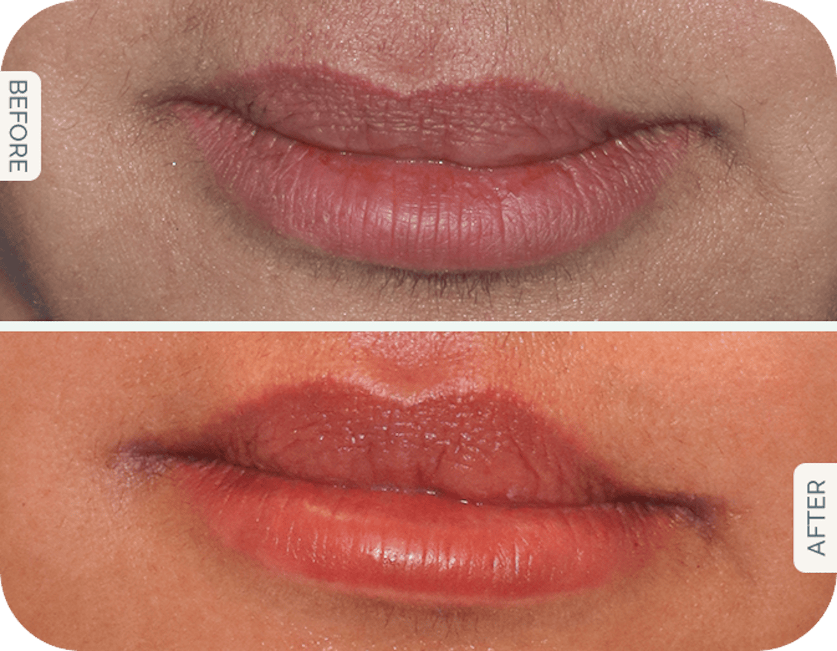 Miami Lip Lift Before & After Gallery - Patient 646615 - Image 1 - The Chopra Plastic Surgery Center