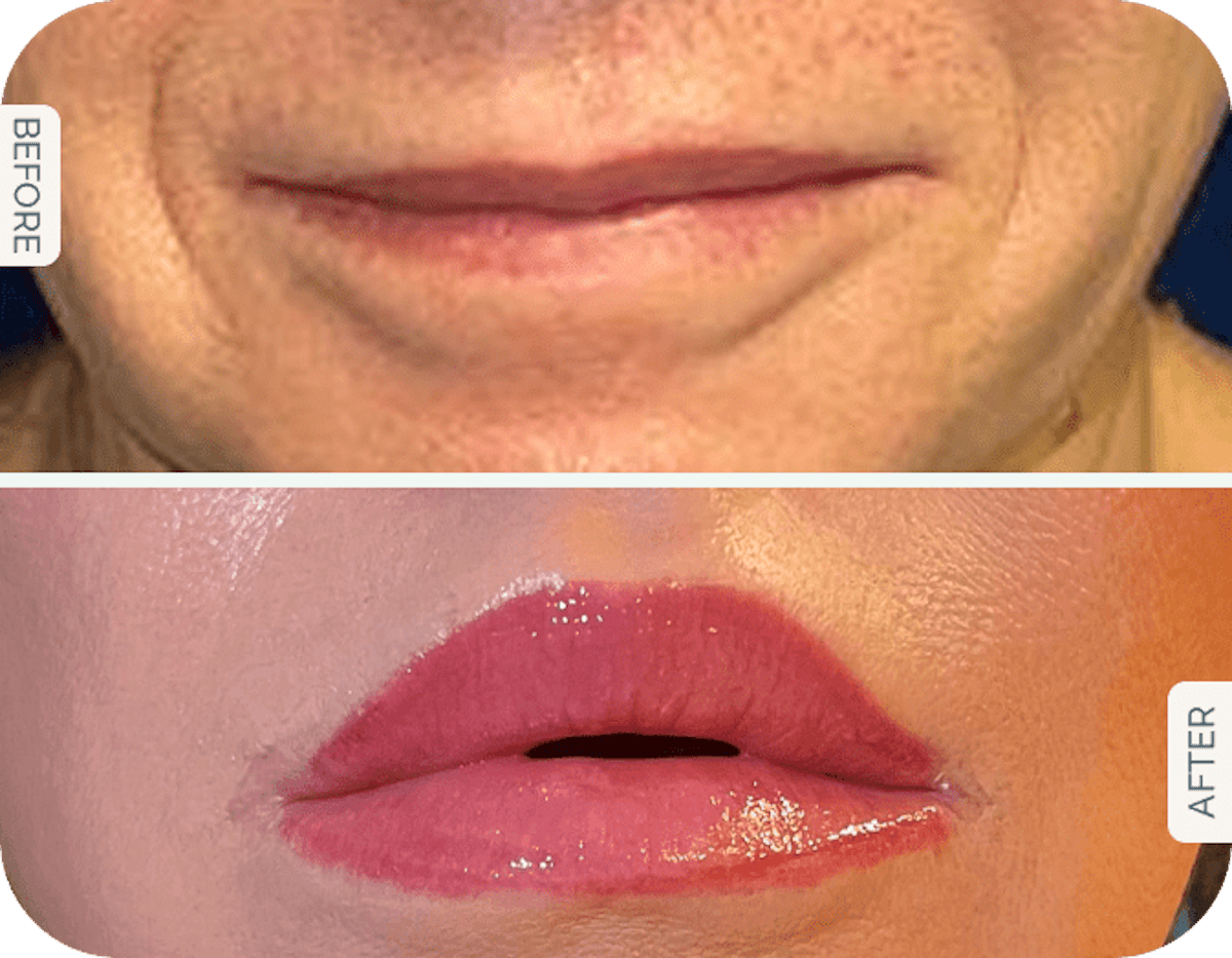 Miami Lip Lift Before & After Gallery - Patient 132241 - Image 1 - The Chopra Plastic Surgery Center