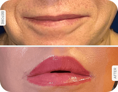 Miami Lip Lift Before & After Gallery - Patient 132241 - Image 1 - The Chopra Plastic Surgery Center