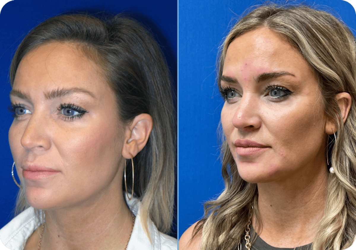 Miami Lip Lift Before & After Gallery - Patient 157349 - Image 1 - The Chopra Plastic Surgery Center