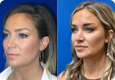 Miami Lip Lift Before & After Gallery - Patient 157349 - Image 1 - The Chopra Plastic Surgery Center