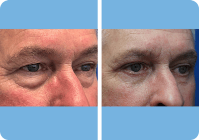 Miami Lower Eyelid Lift Before & After Gallery - Patient 845590 - Image 1 - The Chopra Plastic Surgery Center