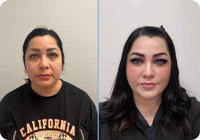 Miami Lower Eyelid Lift Before & After Gallery - Patient 388503 - Image 1 - The Chopra Plastic Surgery Center
