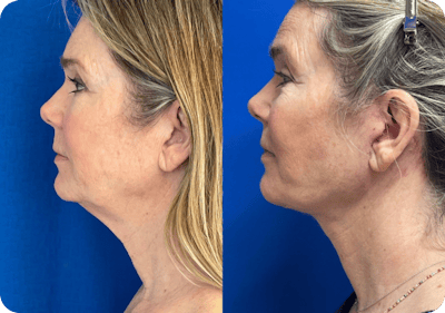 Miami Facelift/Neck Lift Before & After Gallery - Patient 363310 - Image 1 - The Chopra Plastic Surgery Center