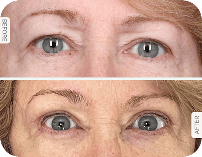 Miami Upper Eyelid Lift Before & After Gallery - Patient 104316 - Image 1 - The Chopra Plastic Surgery Center