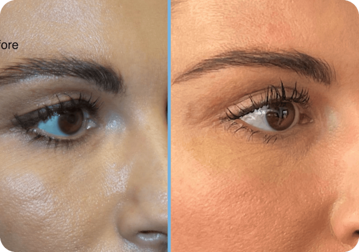 Miami Upper Eyelid Lift Before & After Gallery - Patient 329126 - Image 1 - The Chopra Plastic Surgery Center