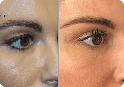 Miami Upper Eyelid Lift Before & After Gallery - Patient 329126 - Image 1 - The Chopra Plastic Surgery Center