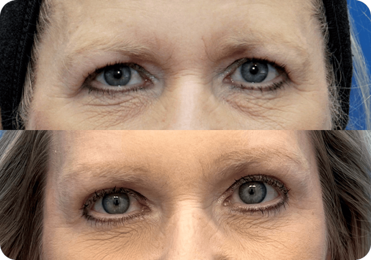 Miami Upper Eyelid Lift Before & After Gallery - Patient 331159 - Image 1 - The Chopra Plastic Surgery Center