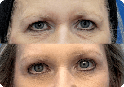 Miami Upper Eyelid Lift Before & After Gallery - Patient 331159 - Image 1 - The Chopra Plastic Surgery Center