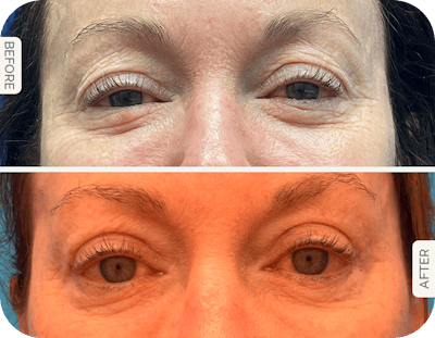 Miami Upper Eyelid Lift Before & After Gallery - Patient 354039 - Image 1 - The Chopra Plastic Surgery Center