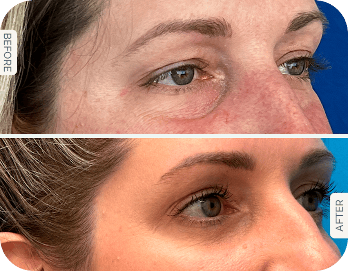 Miami Upper Eyelid Lift Before & After Gallery - Patient 201788 - Image 1 - The Chopra Plastic Surgery Center