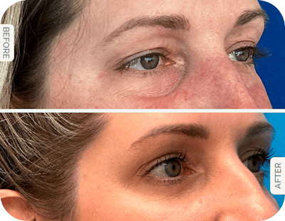 Miami Upper Eyelid Lift Before & After Gallery - Patient 201788 - Image 1 - The Chopra Plastic Surgery Center