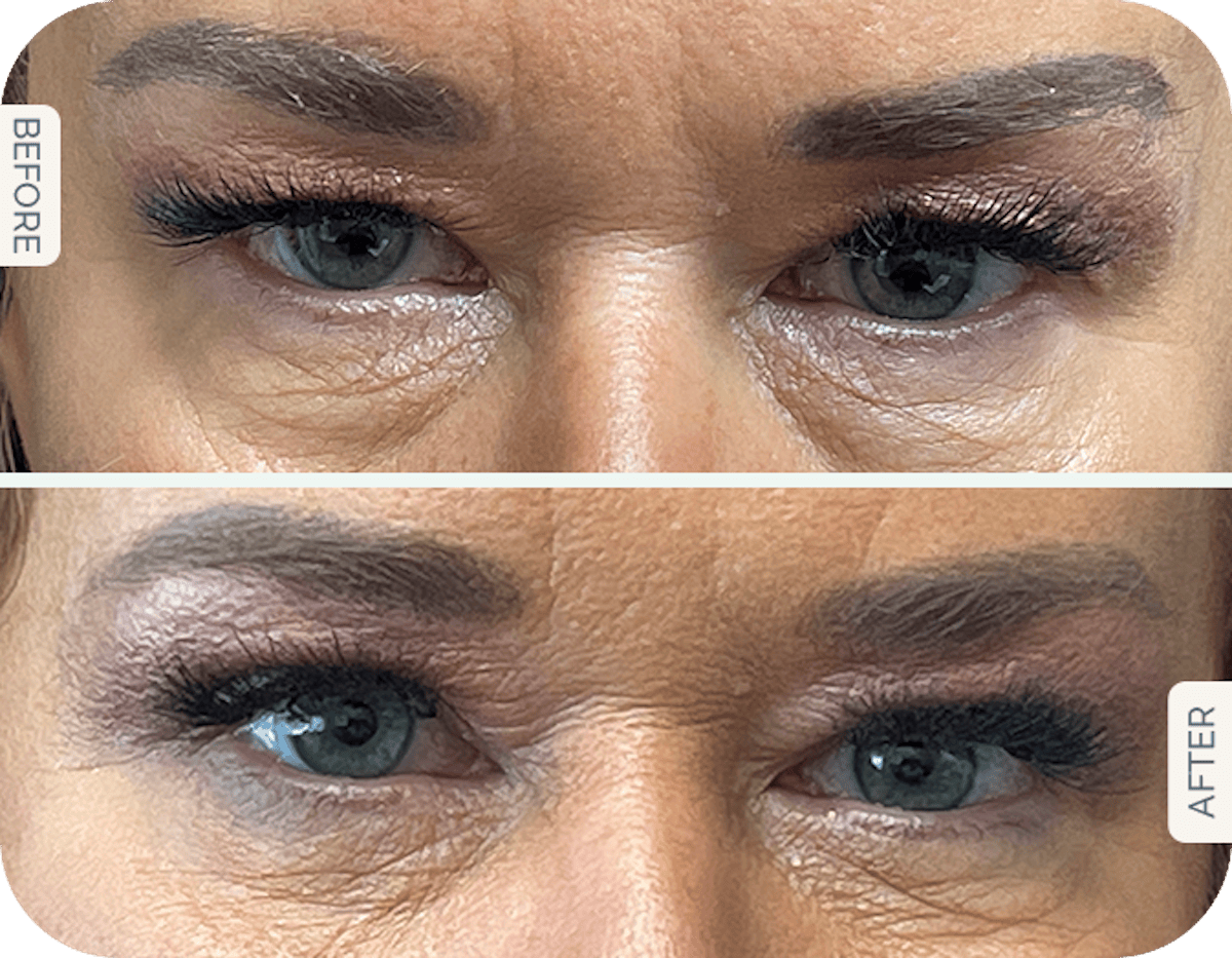 Miami Upper Eyelid Lift Before & After Gallery - Patient 118540 - Image 1 - The Chopra Plastic Surgery Center