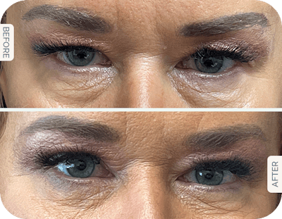 Miami Upper Eyelid Lift Before & After Gallery - Patient 118540 - Image 1 - The Chopra Plastic Surgery Center